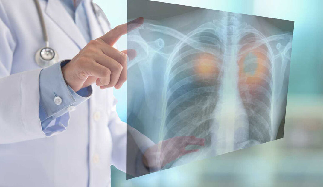 Fighting Bone Cancer