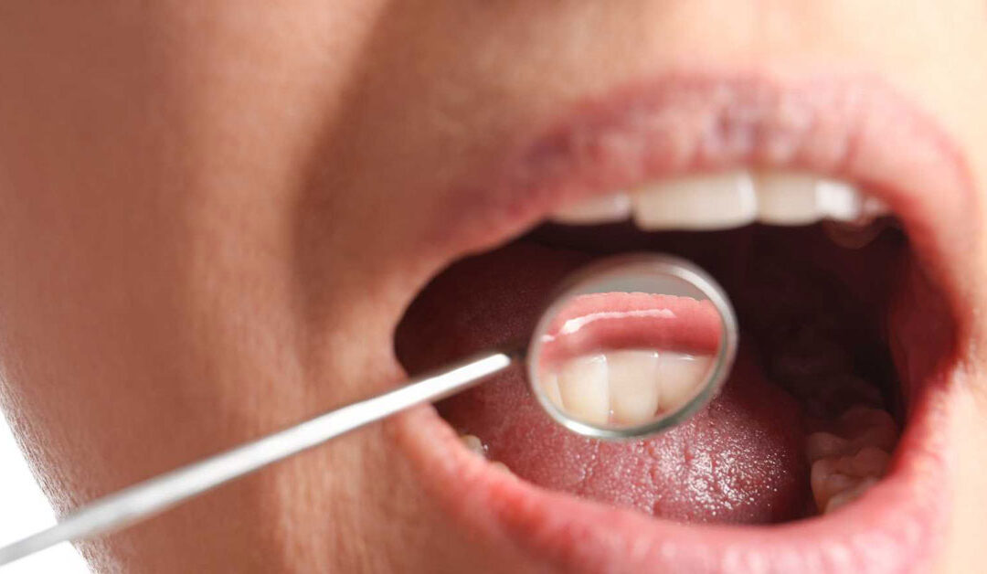 Oral Cancer